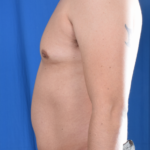 VASER Hi Def Liposuction Before & After Patient #5698