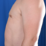 Gynecomastia Before & After Patient #5825