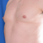 Gynecomastia Before & After Patient #5825