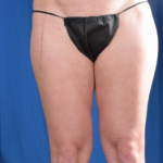 Legs Liposuction Before & After Patient #5830