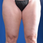 Legs Liposuction Before & After Patient #5835