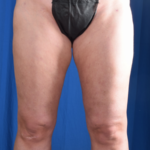 Legs Liposuction Before & After Patient #5835