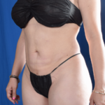 Standard Liposuction Before & After Patient #5844