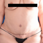 Tummy Tuck Before & After Patient #5850