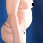 Tummy Tuck Before & After Patient #5850