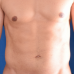 VASER Hi Def Liposuction Before & After Patient #5864