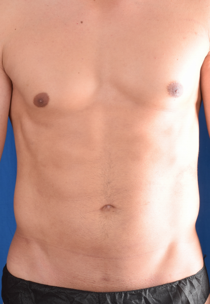 VASER Hi Def Liposuction Before & After Patient #5864