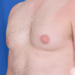 Gynecomastia Before & After Patient #5937