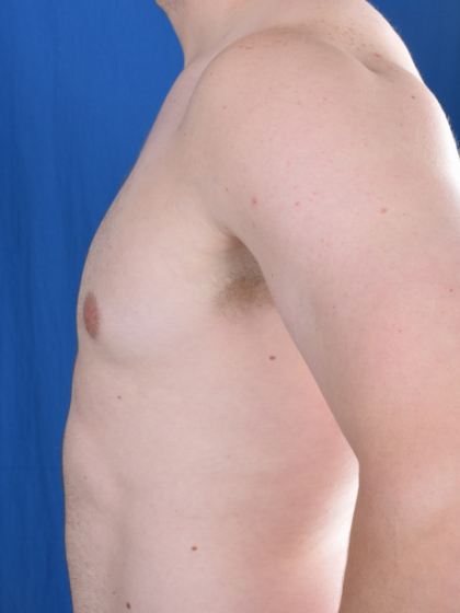 Gynecomastia Before & After Patient #5937