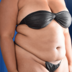 Standard Liposuction Before & After Patient #5950
