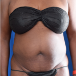 Tummy Tuck Before & After Patient #5955