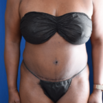 Tummy Tuck Before & After Patient #5955