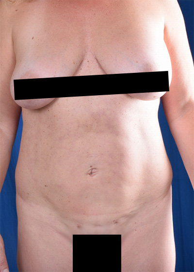 Standard Liposuction Before & After Patient #6035