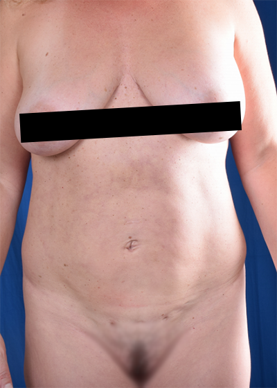Standard Liposuction Before & After Patient #6035