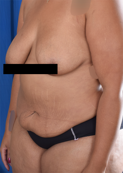 Standard Liposuction Before & After Patient #6042