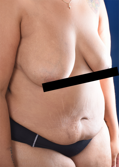 Standard Liposuction Before & After Patient #6042
