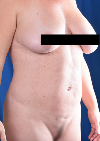 Standard Liposuction Before & After Patient #6035