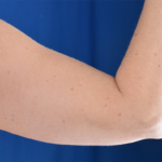 Arms Liposuction Before & After Patient #5984