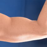 Arms Liposuction Before & After Patient #5984