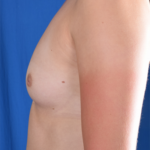 Breast Augmentation Before & After Patient #5989