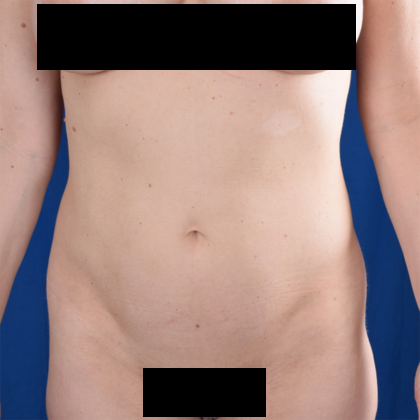 VASER Hi Def Liposuction Before & After Patient #6100