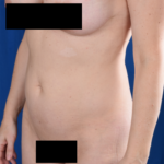 VASER Hi Def Liposuction Before & After Patient #6100