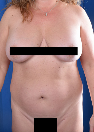 Standard Liposuction Before & After Patient #6035