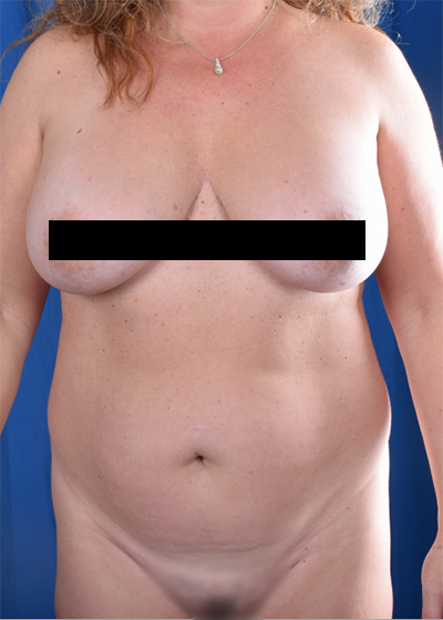 Standard Liposuction Before & After Patient #6035