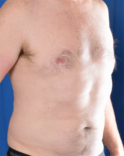 Gynecomastia Before & After Patient #6009