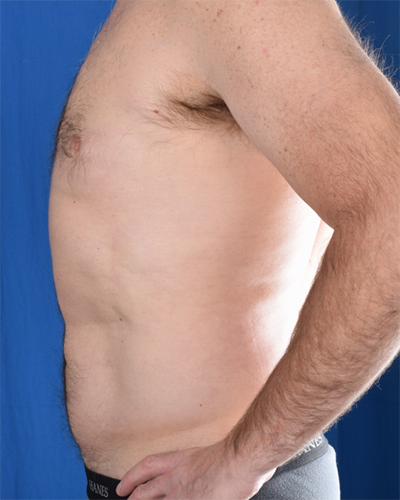 Gynecomastia Before & After Patient #6009