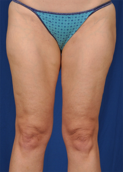 Legs Liposuction Before & After Patient #6016