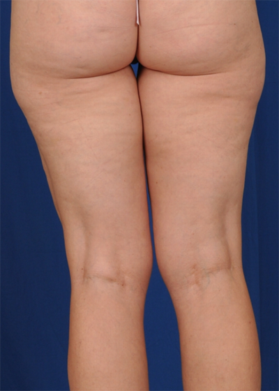Legs Liposuction Before & After Patient #6016
