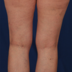 Legs Liposuction Before & After Patient #6025