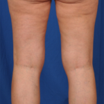 Legs Liposuction Before & After Patient #6025