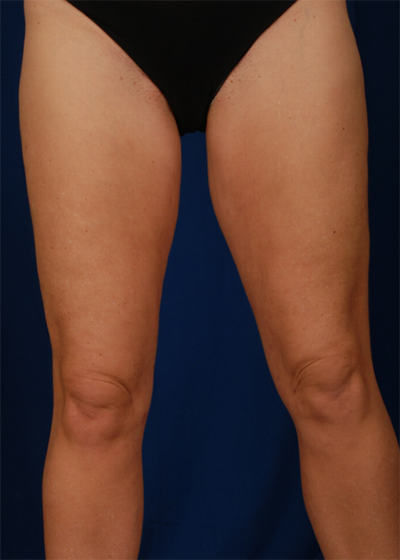 Legs Liposuction Before & After Patient #6030