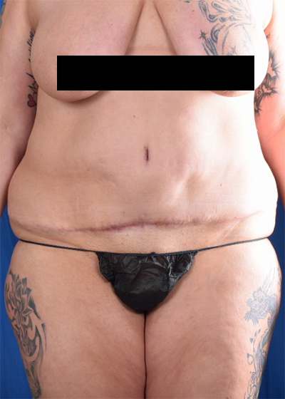 Tummy Tuck Before & After Patient #6047