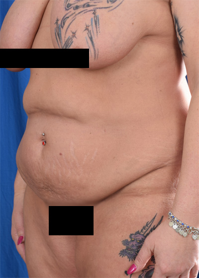 Tummy Tuck Before & After Patient #6047
