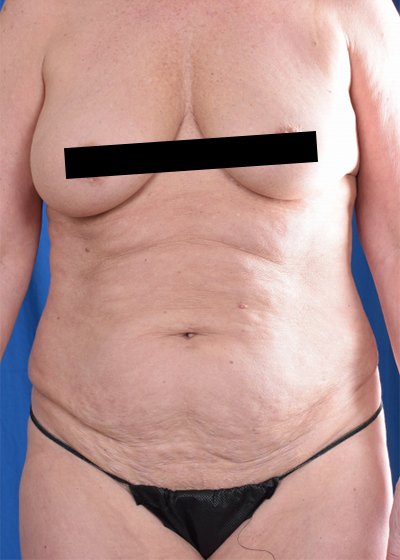Tummy Tuck Before & After Patient #6056