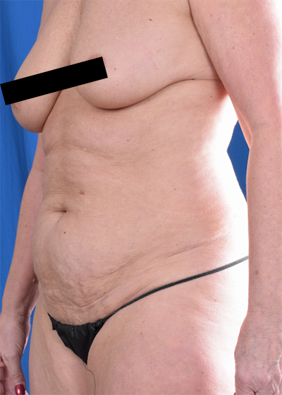 Tummy Tuck Before & After Patient #6056