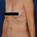 Tummy Tuck Before & After Patient #6067