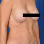 Tummy Tuck Before & After Patient #6067