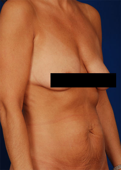 Tummy Tuck Before & After Patient #6072