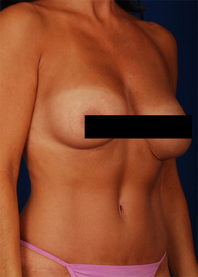 Tummy Tuck Before & After Patient #6072