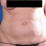 Tummy Tuck Before & After Patient #6079