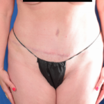 Tummy Tuck Before & After Patient #6079