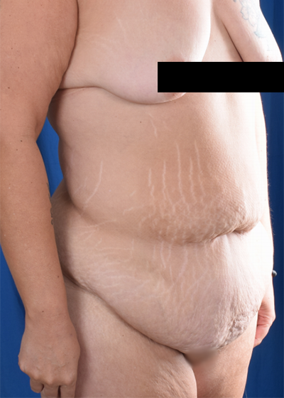 Tummy Tuck Before & After Patient #6086