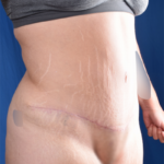 Tummy Tuck Before & After Patient #6086