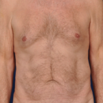 Tummy Tuck Before & After Patient #6093
