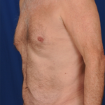 Tummy Tuck Before & After Patient #6093
