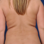 VASER Hi Def Liposuction Before & After Patient #6107